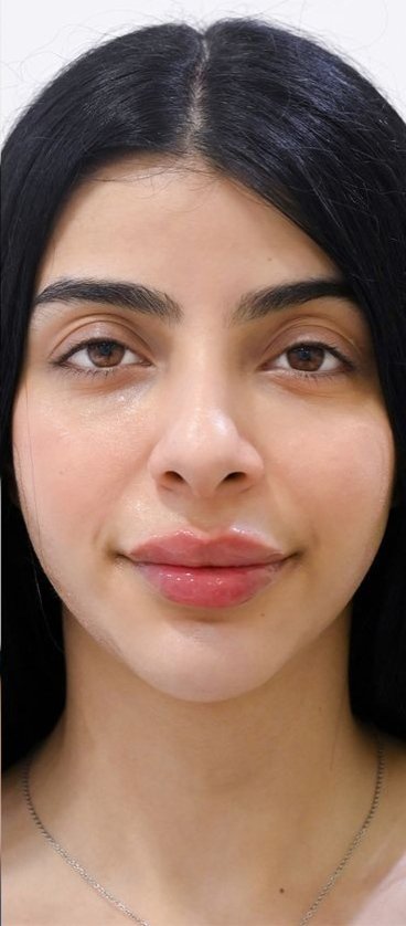 Before - Pigmentation Treatment
