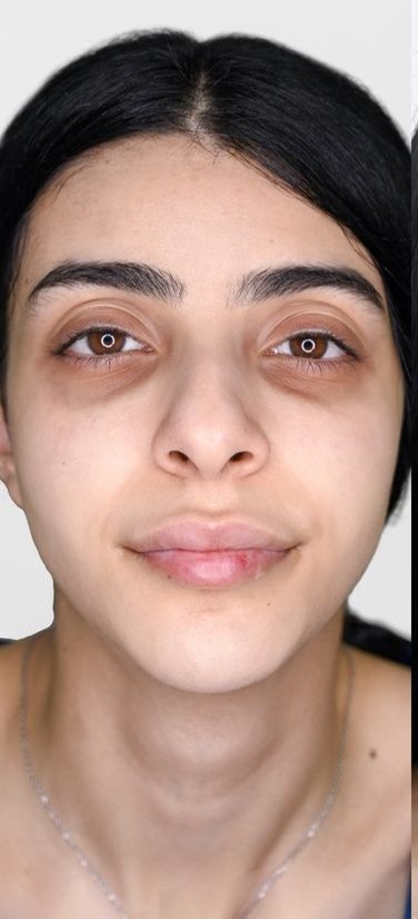 After - Pigmentation Treatment